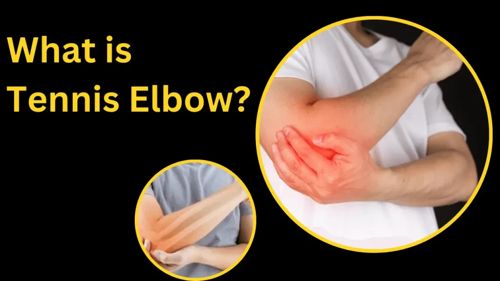WHAT IS TENNIS ELBOW